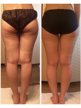 リクラ 北千住(Reclat)/1回の効果でこんなに変化が