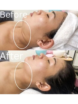 ミセル(MISEL2nd)/首のしわケアもお任せ★