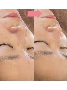 ナルシス(Narcissus)/【毛穴】ハイドラフェイシャル