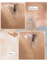 ピーチ ローズ(peach rose)/小じわ　ビフォーアフター