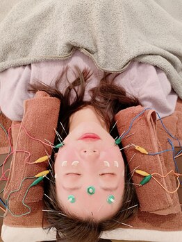 鍼呼灸 森の音/美容鍼に電気を流します！