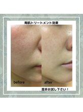 レガ(LEGA)/REVIハーブピーリング♪