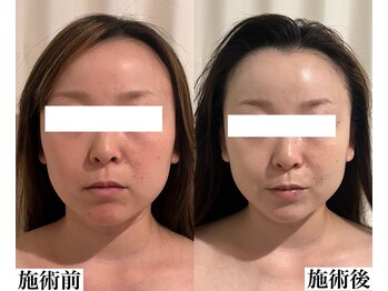 フェミナ(femna)/ポテンツァフェイシャル