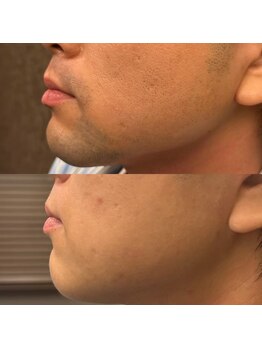 フェリーバ 流山店(FELIVA)/濃いお髭もお任せください。