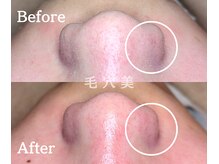 毛穴美/メンズの毛穴悩みは毛穴美へGO！