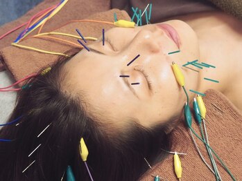 ビハダ(BIHADA)の写真/【#美容鍼#小顔】全顔と頭皮に40～50本！鍼×微弱電流で小顔・エラ張り・たるみ徹底改善◎60分 ¥4950