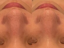 ポーデベロア(Peau des velours)/陶肌トリートメント初回のお客様