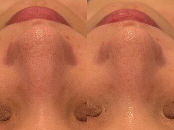 ポーデベロア(Peau des velours)/陶肌トリートメント初回のお客様