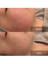 ラヴニール(L'avenir)/花粉からの痒みや赤みに◎