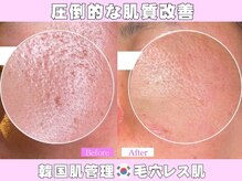 小顔専門カンナムビューティー 麻布十番店【ララピール/ハーブピーリング/小顔/痩身】/オンダリフト/麻布十番／六本木