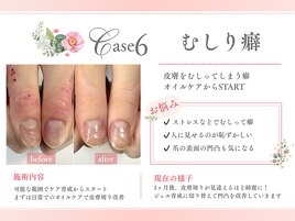 むしり癖の悩み　ケア育成