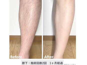 グリシーヌ(GLYCINE)/脱毛の効果★