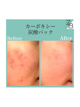 ザラハビューティー(ZARAHA Beauty)/炭酸パック