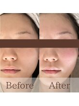 凪眠/小顔リンパフェイシャルの効果17