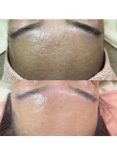 メイト(mate)/肌質改善