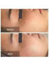 ルポアミ 代々木上原(REPOS AMI)/プラズマフェイシャル 5回の変化