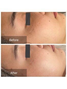 ルポアミ 代々木上原(REPOS AMI)/プラズマフェイシャル 5回の変化