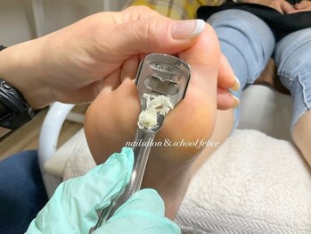 フェリーチェ(nail salon＆school felice)の写真/【巻き爪用のクーポンあり◎】丁寧な施術で自信の持てる素足美人に☆潤いのある綺麗な素足に変身♪