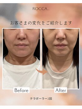 ロッカ(ROCCA..)/テラボーラー