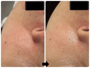 エフェクト 塚口店(effect)/Before After 40代/3回目