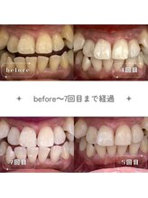 ムダ毛研究所 カンカ 銀座店(Kanka)/ホワイトニングbefore～7回目