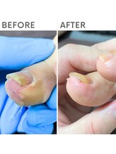 クオッカ(Quokka)/巻き爪ケア