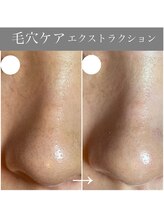 カミーシャ(KaMi-Sha)/【20代】毛穴症例写真