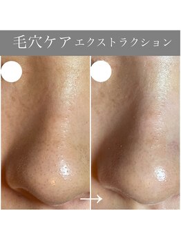 カミーシャ(KaMi-Sha)/【20代】毛穴症例写真