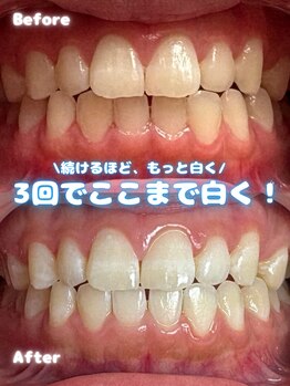 ブライトスマイル 静岡店(Bright Smile)の写真/3回でここまで白くなる！ホワイトニングで輝く歯のケアは継続が大切ですよ★