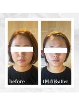 フローフシ∞/【小顔】30代女性症例写真