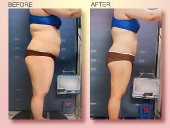 ジュリア オージェ 四条河原町店/ビフォーアフター（脂肪燃焼)