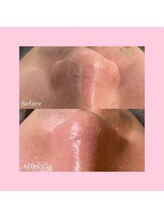 ホワイトラボ 天王寺(White labo)/【施術例】ハイドロフェイシャル