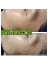 ハナ(HANA)/ハーブトリートメント1回の効果