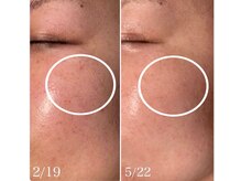 楚々(SOSO)/毛穴縮小！パーンとハリ肌へ！