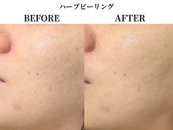 サンビ(SANBI)/ツヤ肌ハーブピーリング♪