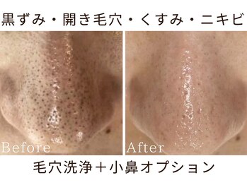 リリアン(lirien)/毛穴/毛穴ケア/毛穴洗浄/駒込