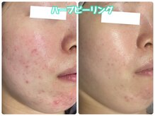 ブロッサム(Blossom)の雰囲気（肌質改善ハーブやピーリング多数◎ニキビケア、肌育、韓国肌に◎）