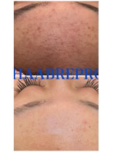 スイートルーム(Sweet Room)/1回の施術効果です。