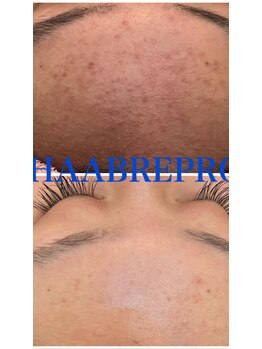 スイートルーム(Sweet Room)/1回の施術効果です。