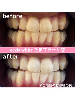 エクシアホワイトニング たまプラーザ店/ビフォーアフター