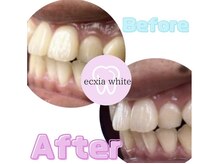 エクシアホワイトニング 静岡駅前店/ビフォーアフター