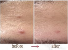 ナチュラーレ 天王寺店(Naturale)/美肌ニキビケア小顔フェイシャル