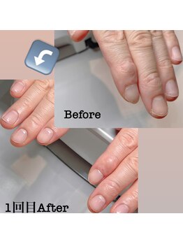 トラブル爪にも!