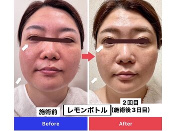 エトワール(etoile)/驚きの変化！2回目施術