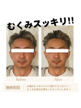 ミラクル(Miracle)/メンズ小顔矯正でむくみスッキリ