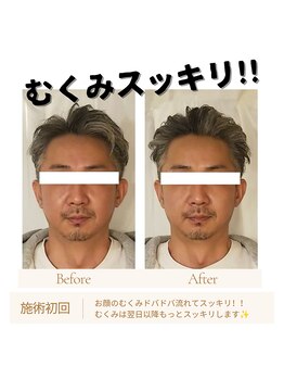 ミラクル(Miracle)/メンズ小顔矯正でむくみスッキリ