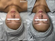 ナチュールムーン(Nature moon.)/ハーブピーリング