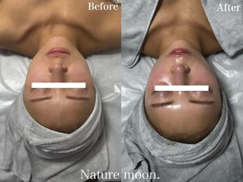 ナチュールムーン(Nature moon.)/ハーブピーリング