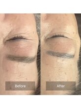 サロンツキ(salon tuki)/【幹細胞ピーリング】施術1回