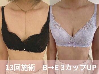 ヒヨコ 池袋西口店(Hiyoko)/バストアップ/育乳(施術13回)